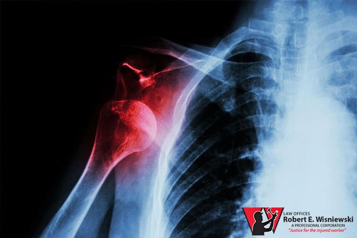 Our Arizona workers’ compensation attorneys can tell you how much compensation is owed for a shoulder injury on the job